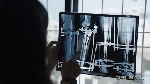 Breaking Bones to Grow Taller in India Breaking Bones to Grow Taller in India
