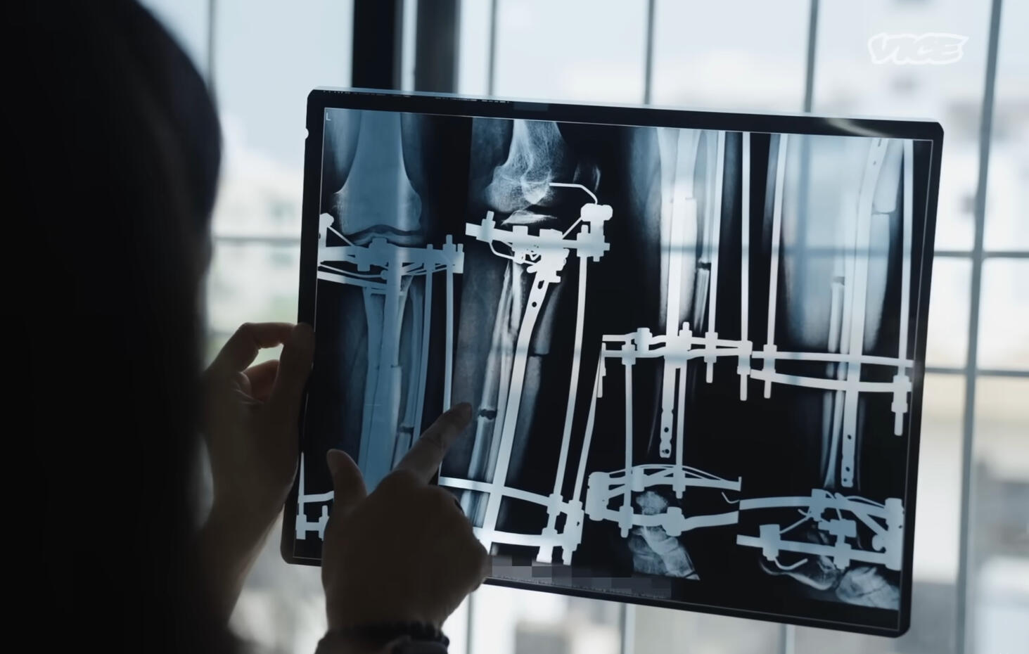 An X-Ray view of the patient's leg with the attached limb-lengthening apparatus An X-Ray view of the patient's leg with the attached limb-lengthening apparatus